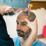 Expectations And Long-Term Outcomes Of Hair Transplants